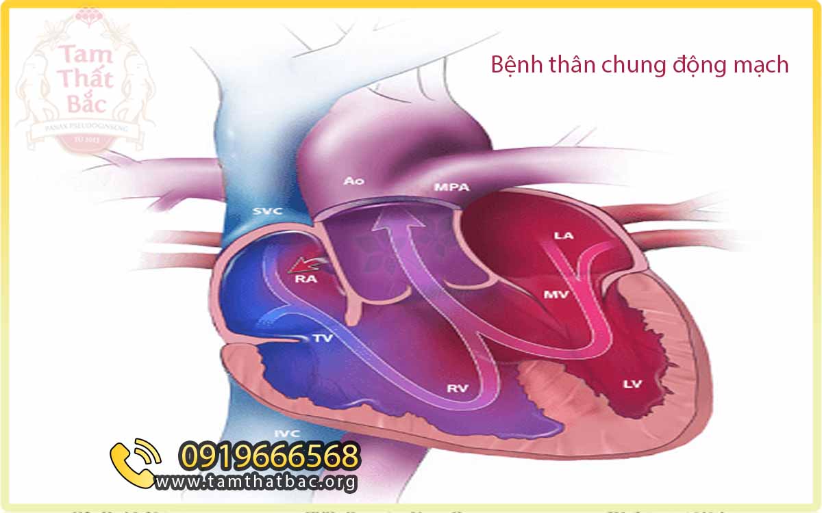 Nguyên nhân gây ra bệnh thân chung động mạch