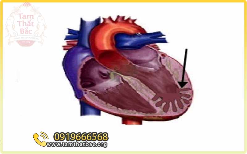 Bệnh Cơ Tim Không Lèn Chặt