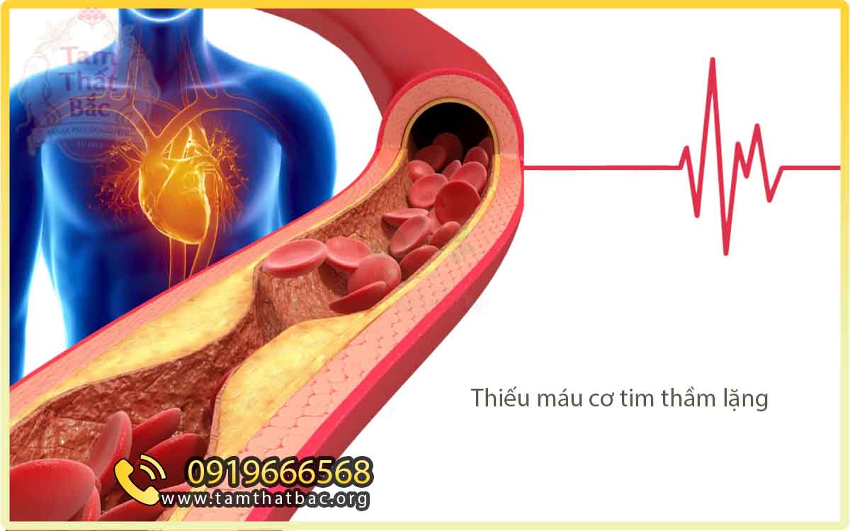 thiếu máu cơ tim thầm lặng (silent myocardial ischemia)